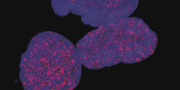 Augmenten els casos de càncer al conjunt de Catalunya